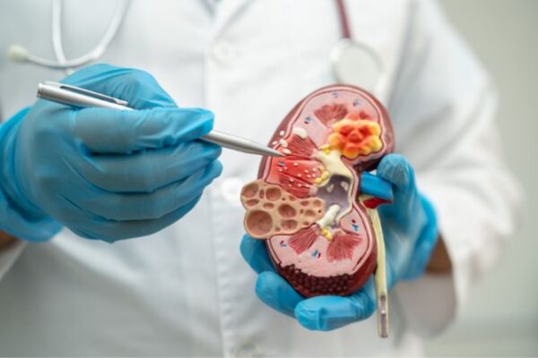 Kidney Stones in Summer | Early Signs, Pain Control, & Prevention