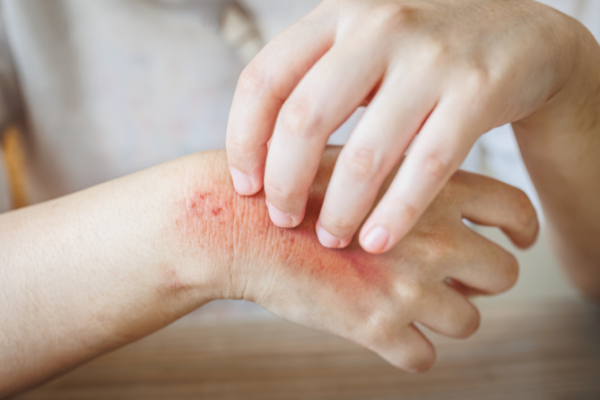 Skin and Fungal Infections in Monsoon: What To Look Out For